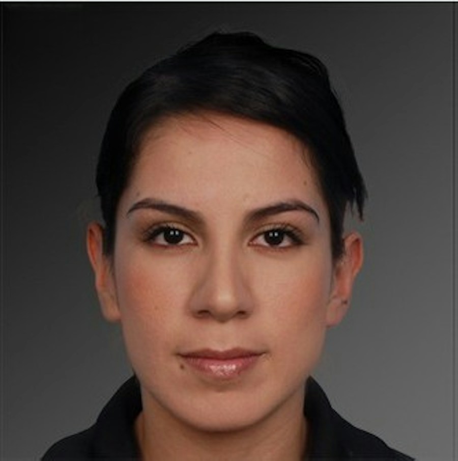Patient 106009292 | Front View | After | Rhinoplasty — Steven Teitelbaum MD -
