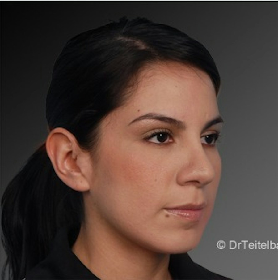 Patient 106009292 | Angle View | After | Rhinoplasty — Steven Teitelbaum MD -