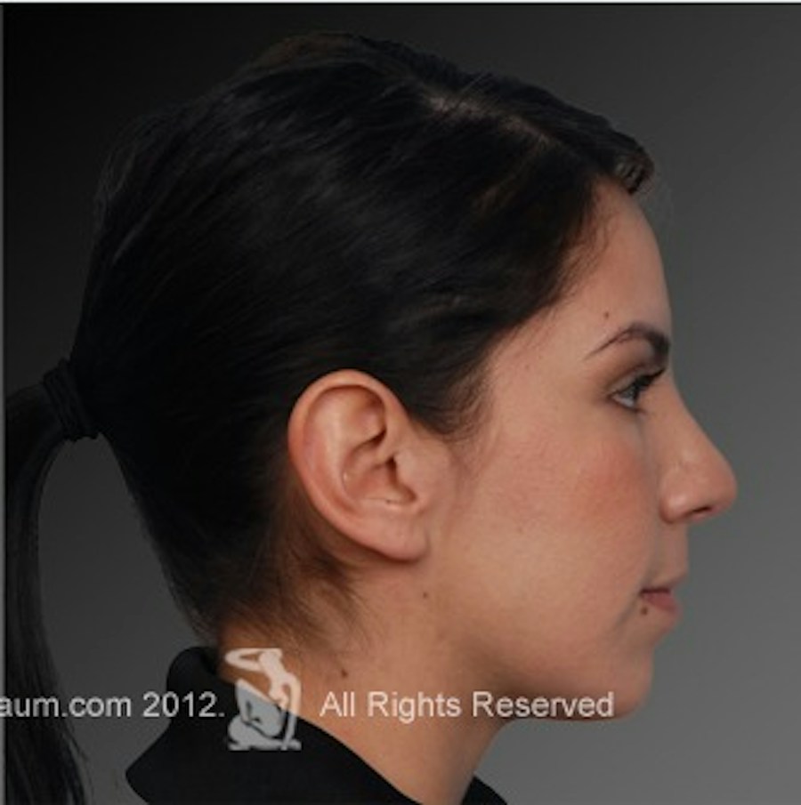 Patient 106009292 | Profile View | After | Rhinoplasty — Steven Teitelbaum MD -