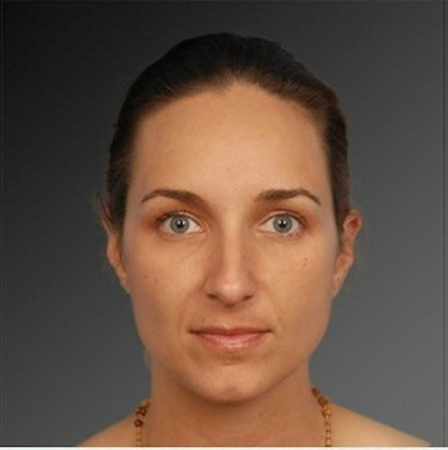 Patient 106009293 | Front View | Before | Rhinoplasty — Steven Teitelbaum MD -