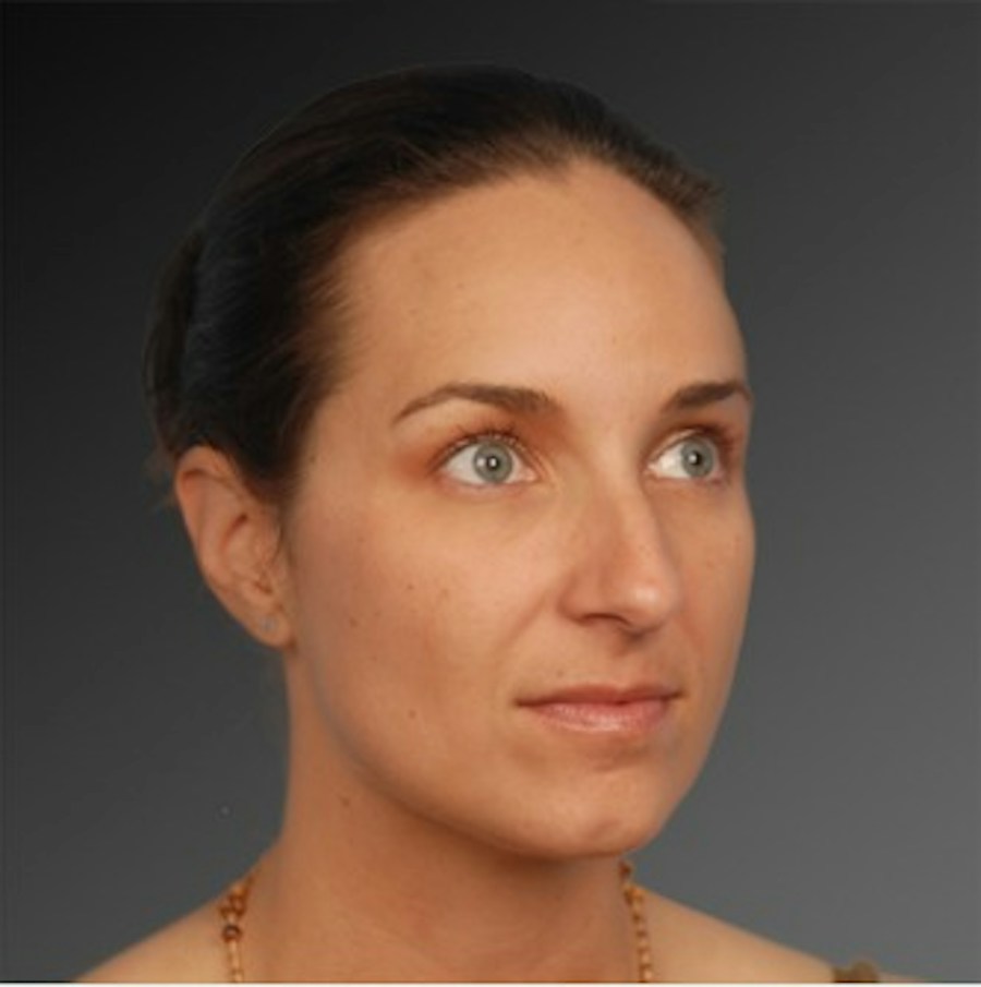 Patient 106009293 | Angle View | Before | Rhinoplasty — Steven Teitelbaum MD -