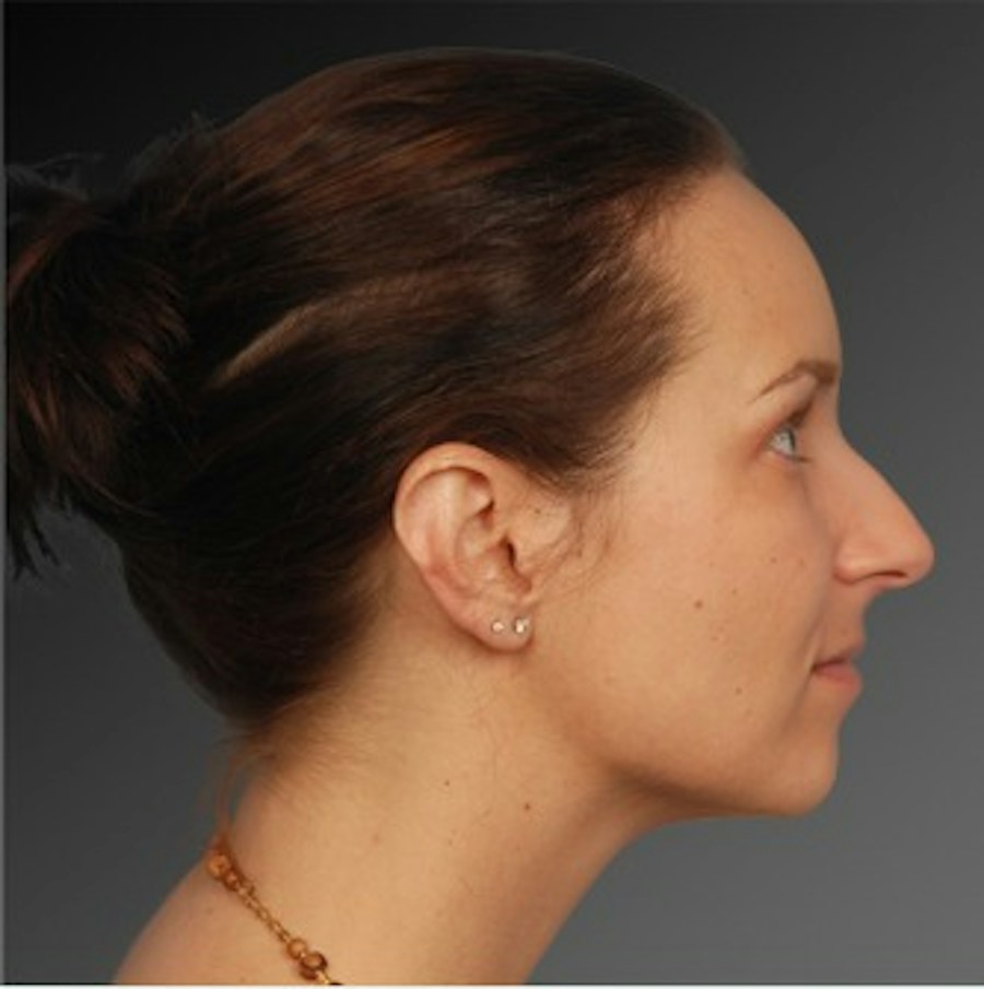 Patient 106009293 | Profile View | Before | Rhinoplasty — Steven Teitelbaum MD -