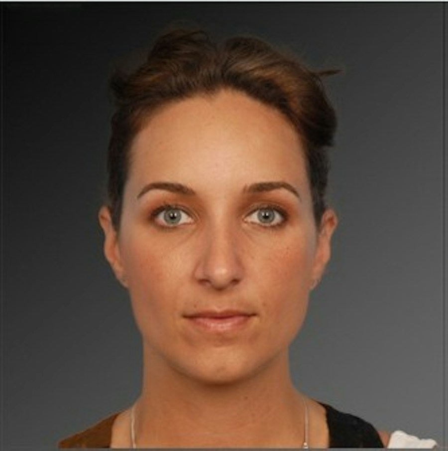 Patient 106009293 | Front View | After | Rhinoplasty — Steven Teitelbaum MD -