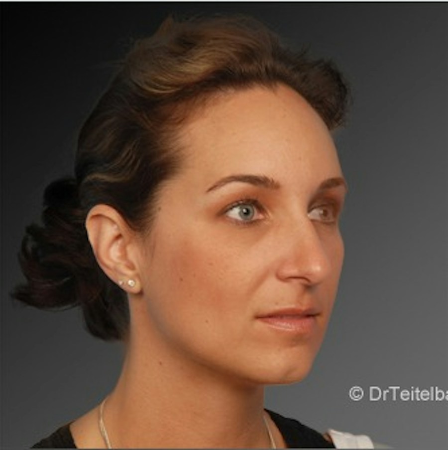 Patient 106009293 | Angle View | After | Rhinoplasty — Steven Teitelbaum MD -