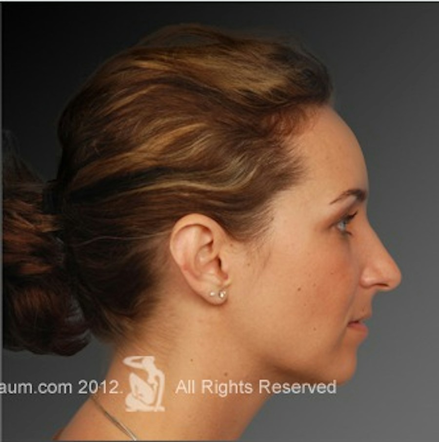 Patient 106009293 | Profile View | After | Rhinoplasty — Steven Teitelbaum MD -