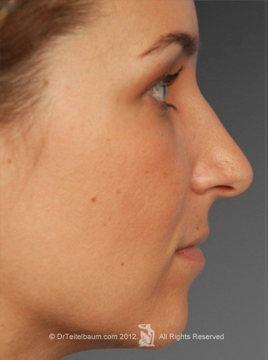 Patient 106009294 | Profile View | After | Rhinoplasty — Steven Teitelbaum MD - Santa Monica