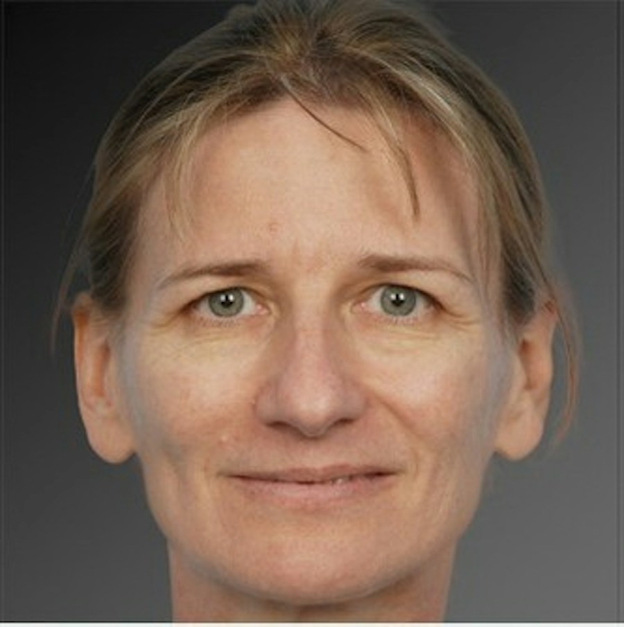Patient 106009295 | Front View | Before | Rhinoplasty — Steven Teitelbaum MD -