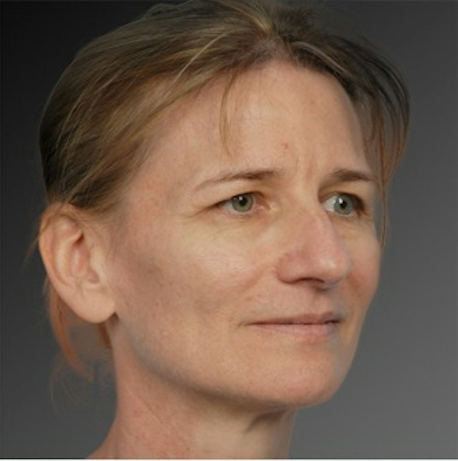 Patient 106009295 | Angle View | Before | Rhinoplasty — Steven Teitelbaum MD -
