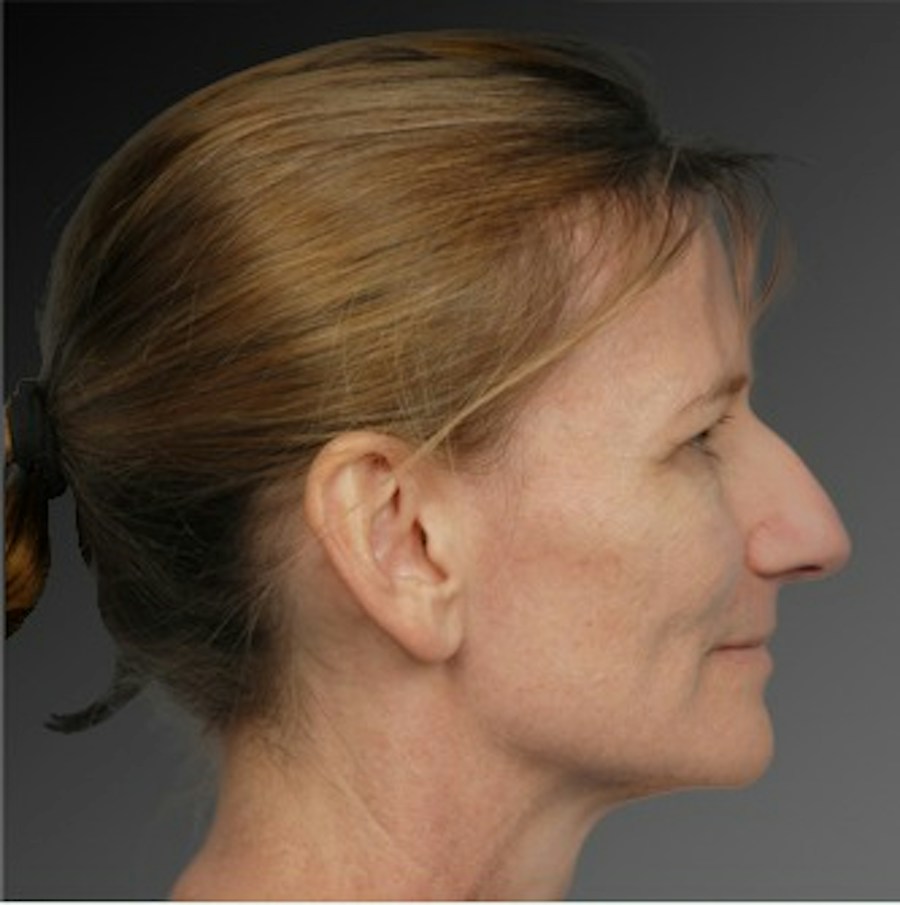 Patient 106009295 | Profile View | Before | Rhinoplasty — Steven Teitelbaum MD -
