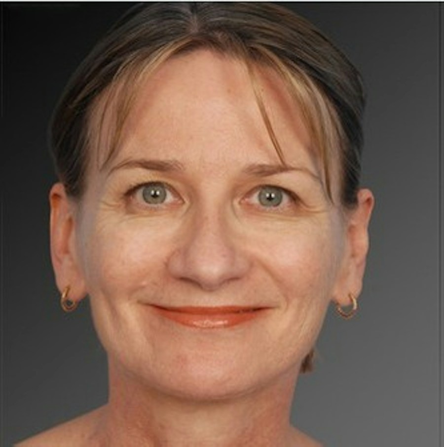 Patient 106009295 | Front View | After | Rhinoplasty — Steven Teitelbaum MD -