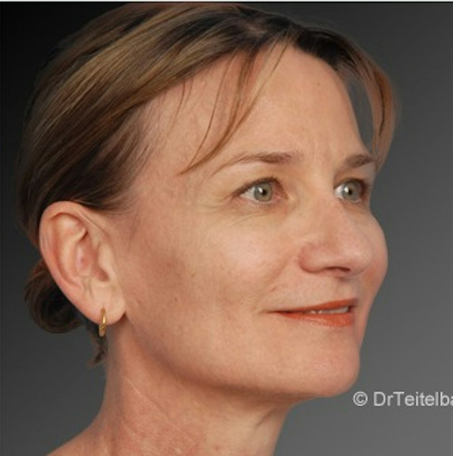 Patient 106009295 | Angle View | After | Rhinoplasty — Steven Teitelbaum MD -