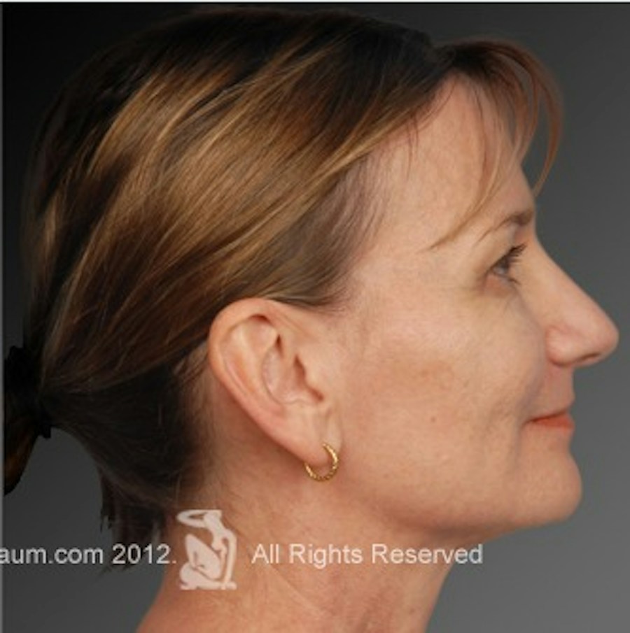 Patient 106009295 | Profile View | After | Rhinoplasty — Steven Teitelbaum MD -