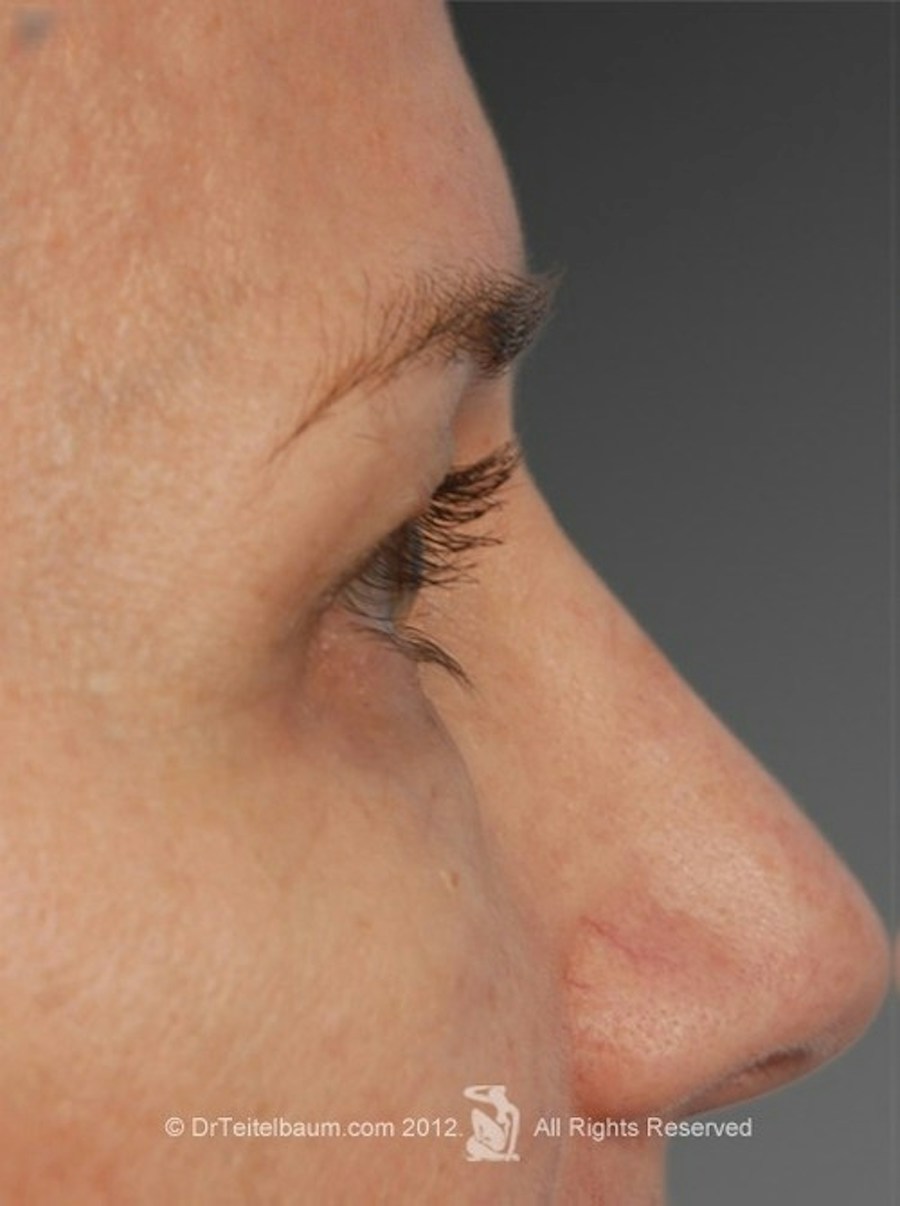 Patient 106009296 | Profile View | After | Rhinoplasty — Steven Teitelbaum MD - Santa Monica