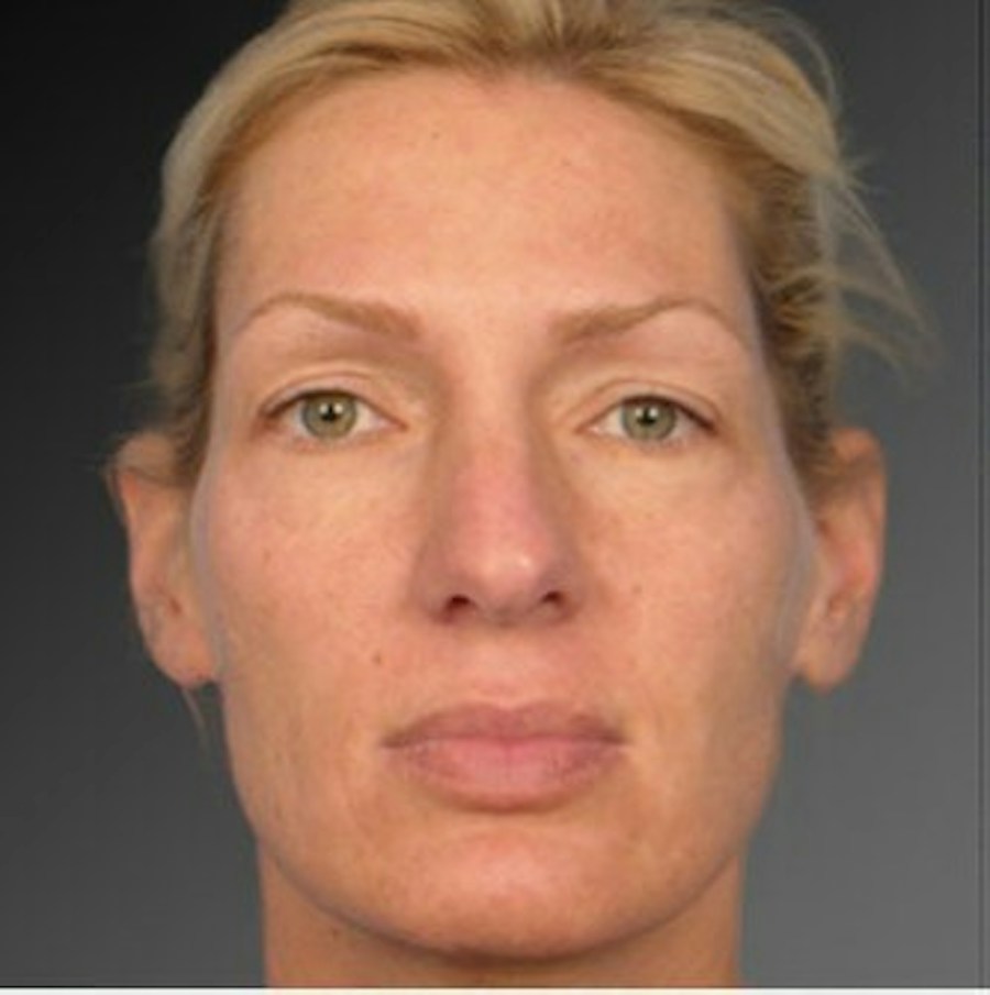 Patient 106009297 | Front View | Before | Rhinoplasty — Steven Teitelbaum MD -