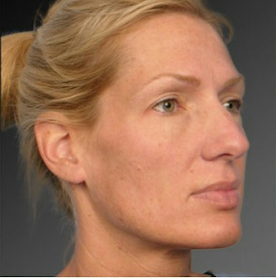 Patient 106009297 | Angle View | Before | Rhinoplasty — Steven Teitelbaum MD -