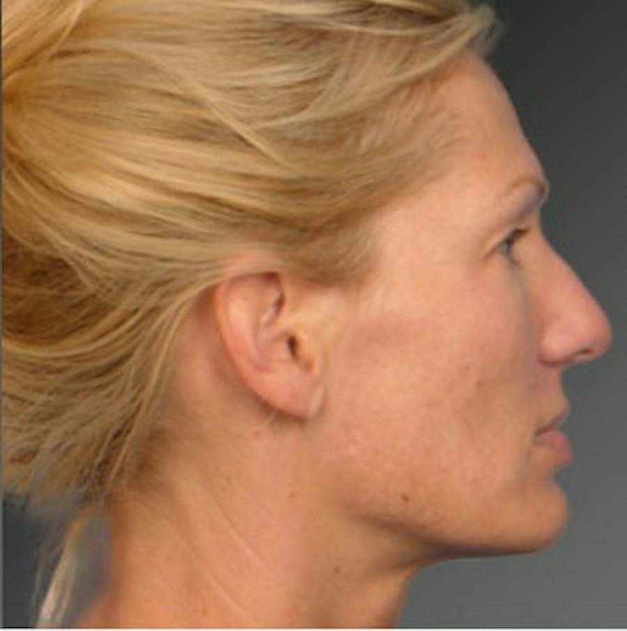 Patient 106009297 | Profile View | Before | Rhinoplasty — Steven Teitelbaum MD -