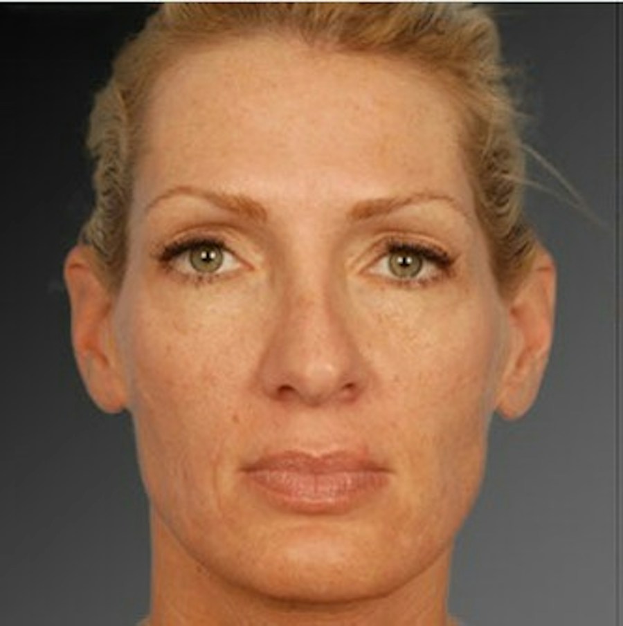 Patient 106009297 | Front View | After | Rhinoplasty — Steven Teitelbaum MD -