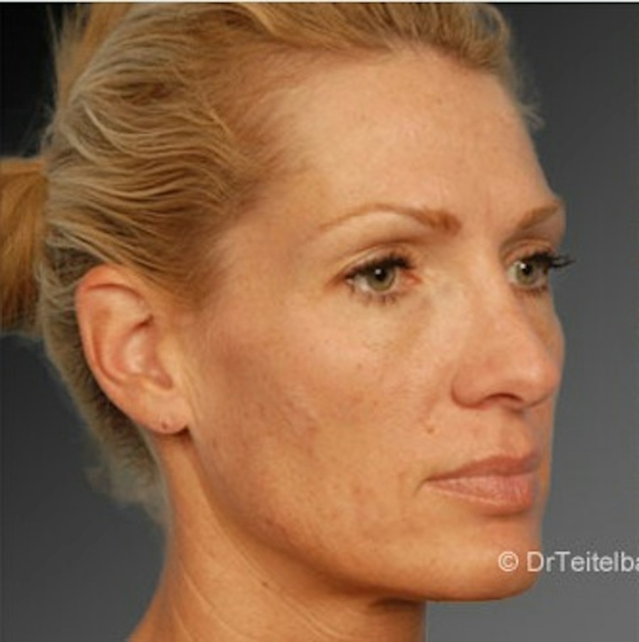Patient 106009297 | Angle View | After | Rhinoplasty — Steven Teitelbaum MD -