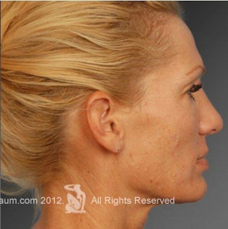 Patient 106009297 | Profile View | After | Rhinoplasty — Steven Teitelbaum MD -
