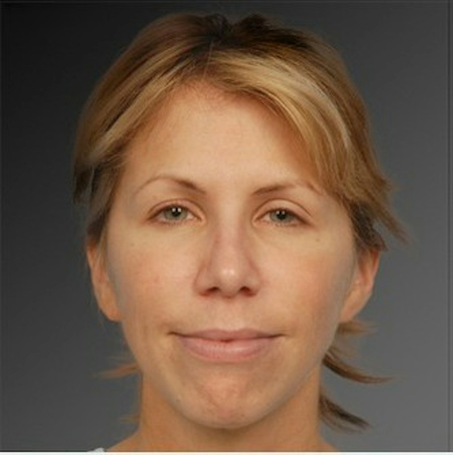 Patient 106009299 | Front View | Before | Rhinoplasty — Steven Teitelbaum MD -