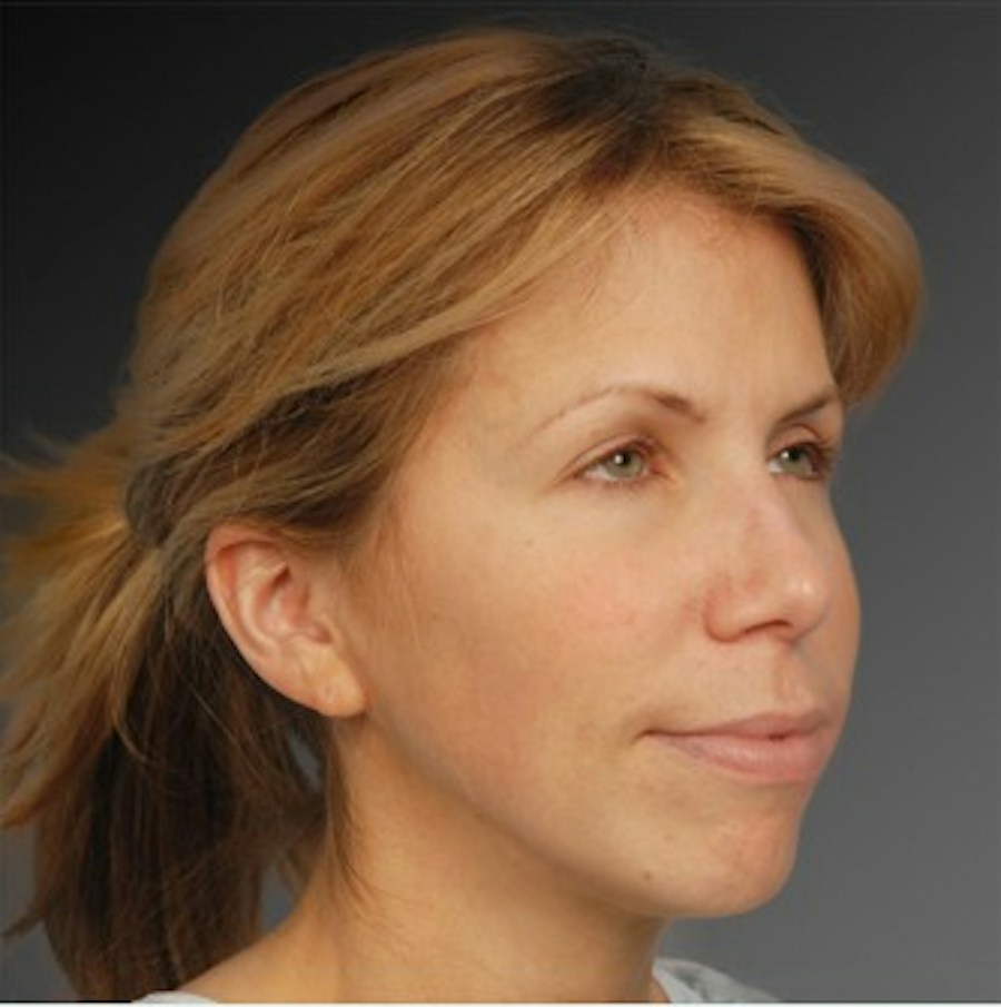 Patient 106009299 | Angle View | Before | Rhinoplasty — Steven Teitelbaum MD -