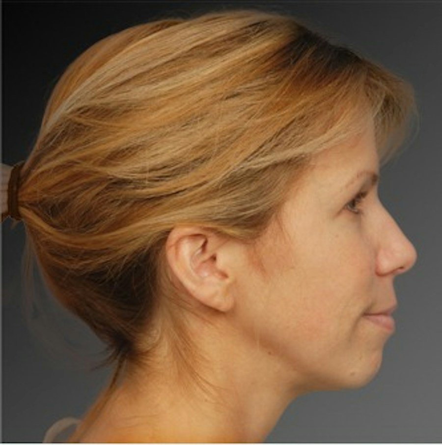 Patient 106009299 | Profile View | Before | Rhinoplasty — Steven Teitelbaum MD -
