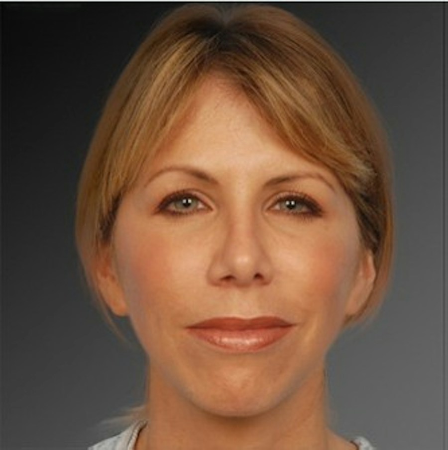 Patient 106009299 | Front View | After | Rhinoplasty — Steven Teitelbaum MD -