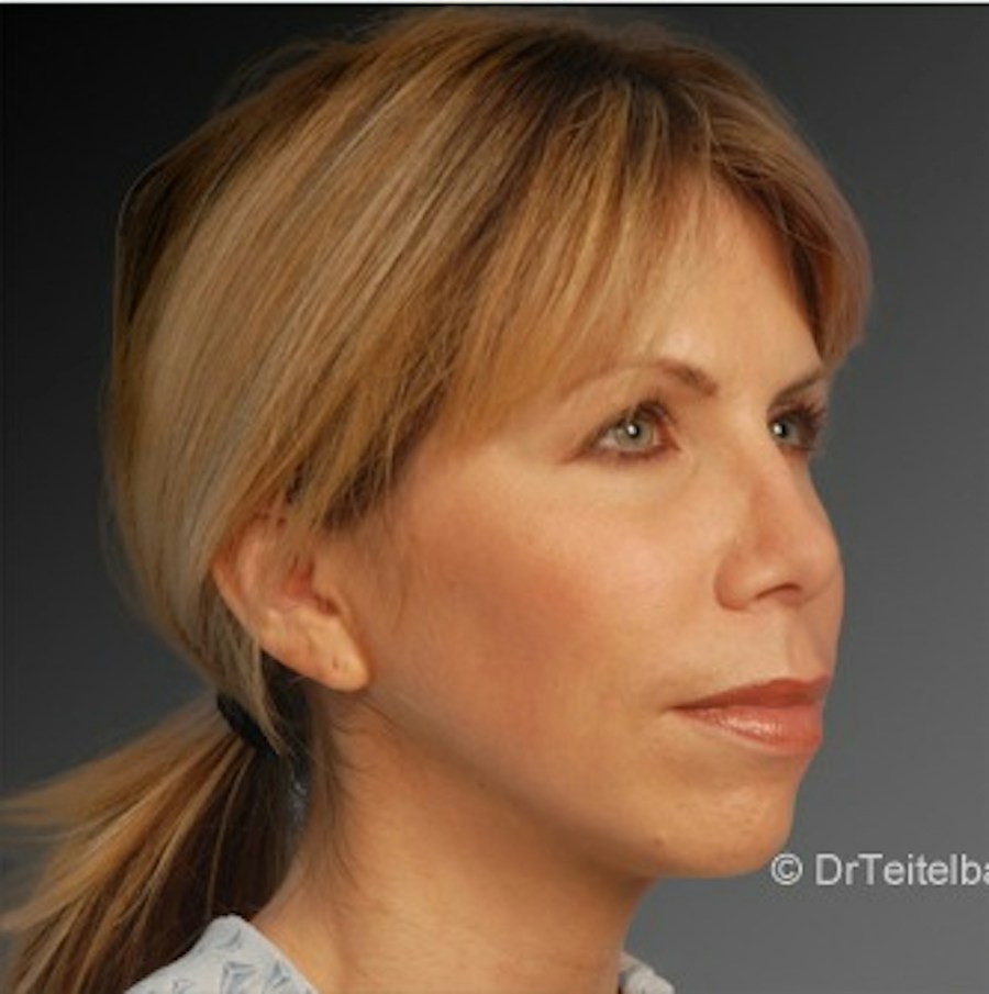 Patient 106009299 | Angle View | After | Rhinoplasty — Steven Teitelbaum MD -