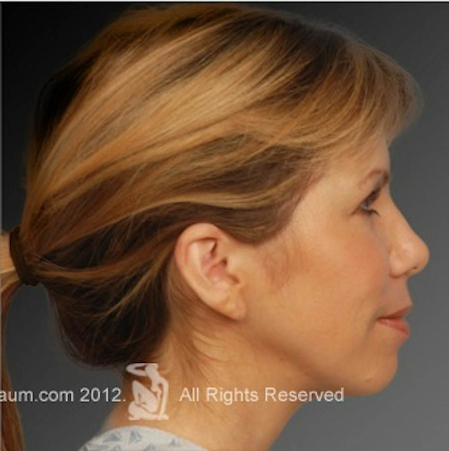 Patient 106009299 | Profile View | After | Rhinoplasty — Steven Teitelbaum MD -