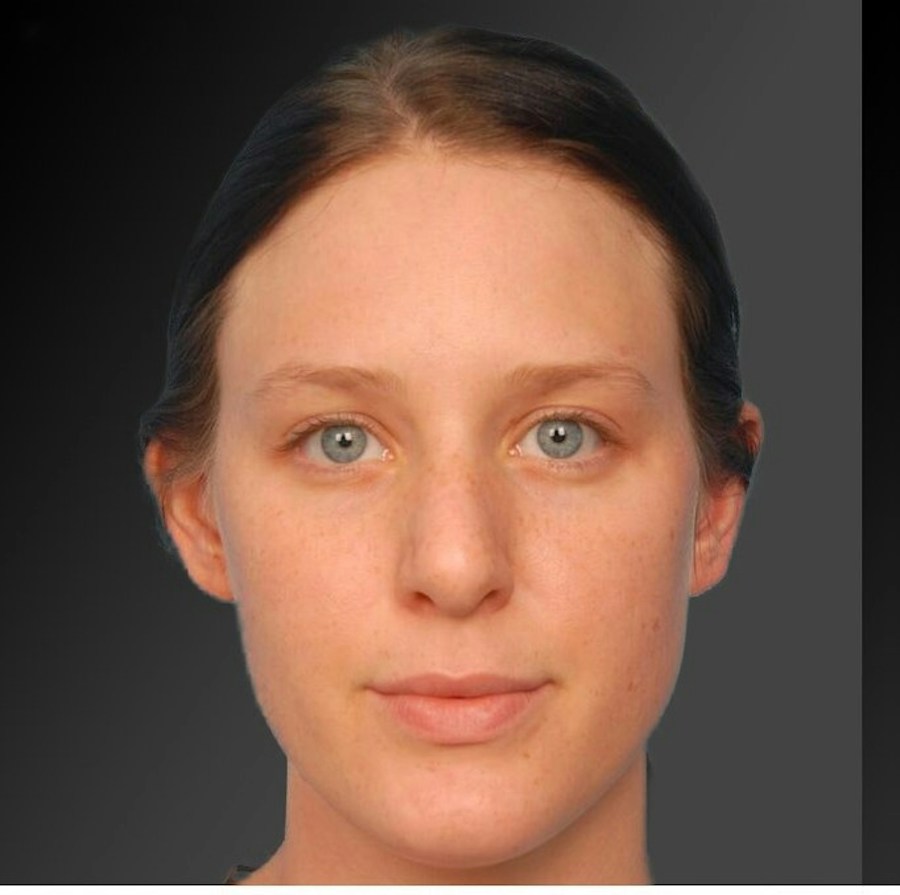Patient 106009300 | Front View | Before | Rhinoplasty — Steven Teitelbaum MD -