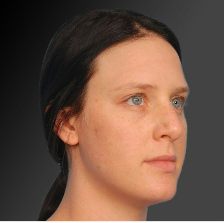 Patient 106009300 | Angle View | Before | Rhinoplasty — Steven Teitelbaum MD -