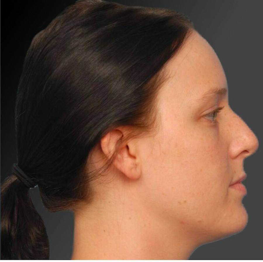 Patient 106009300 | Profile View | Before | Rhinoplasty — Steven Teitelbaum MD -