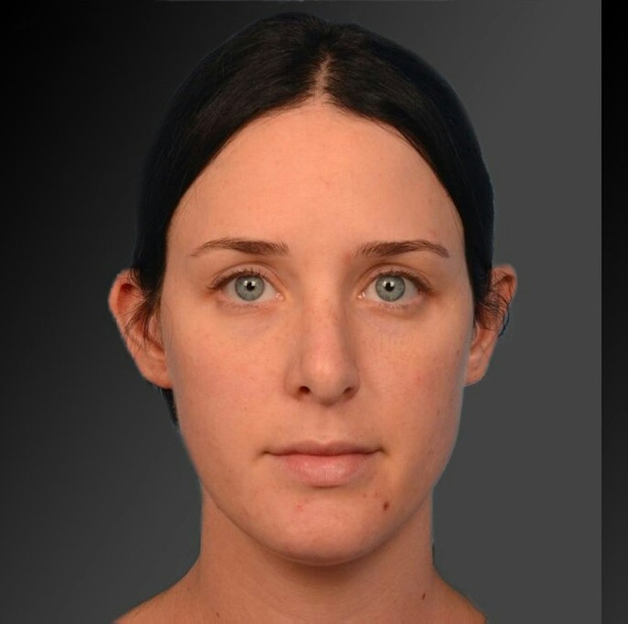 Patient 106009300 | Front View | After | Rhinoplasty — Steven Teitelbaum MD -