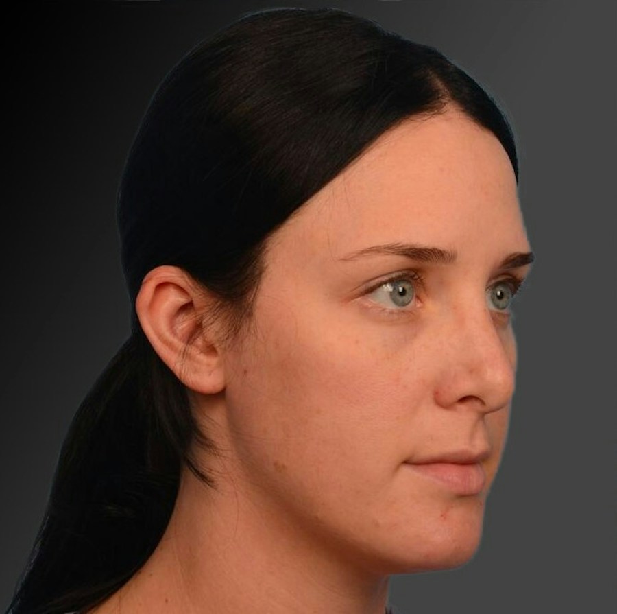Patient 106009300 | Angle View | After | Rhinoplasty — Steven Teitelbaum MD -