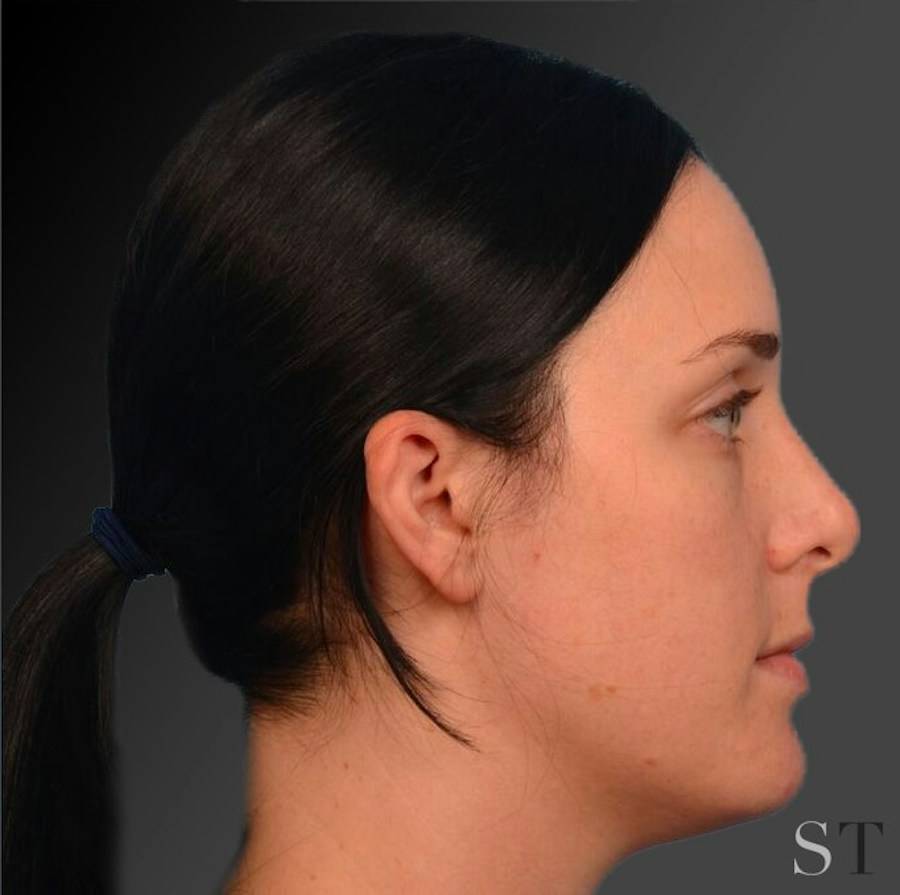 Patient 106009300 | Profile View | After | Rhinoplasty — Steven Teitelbaum MD -