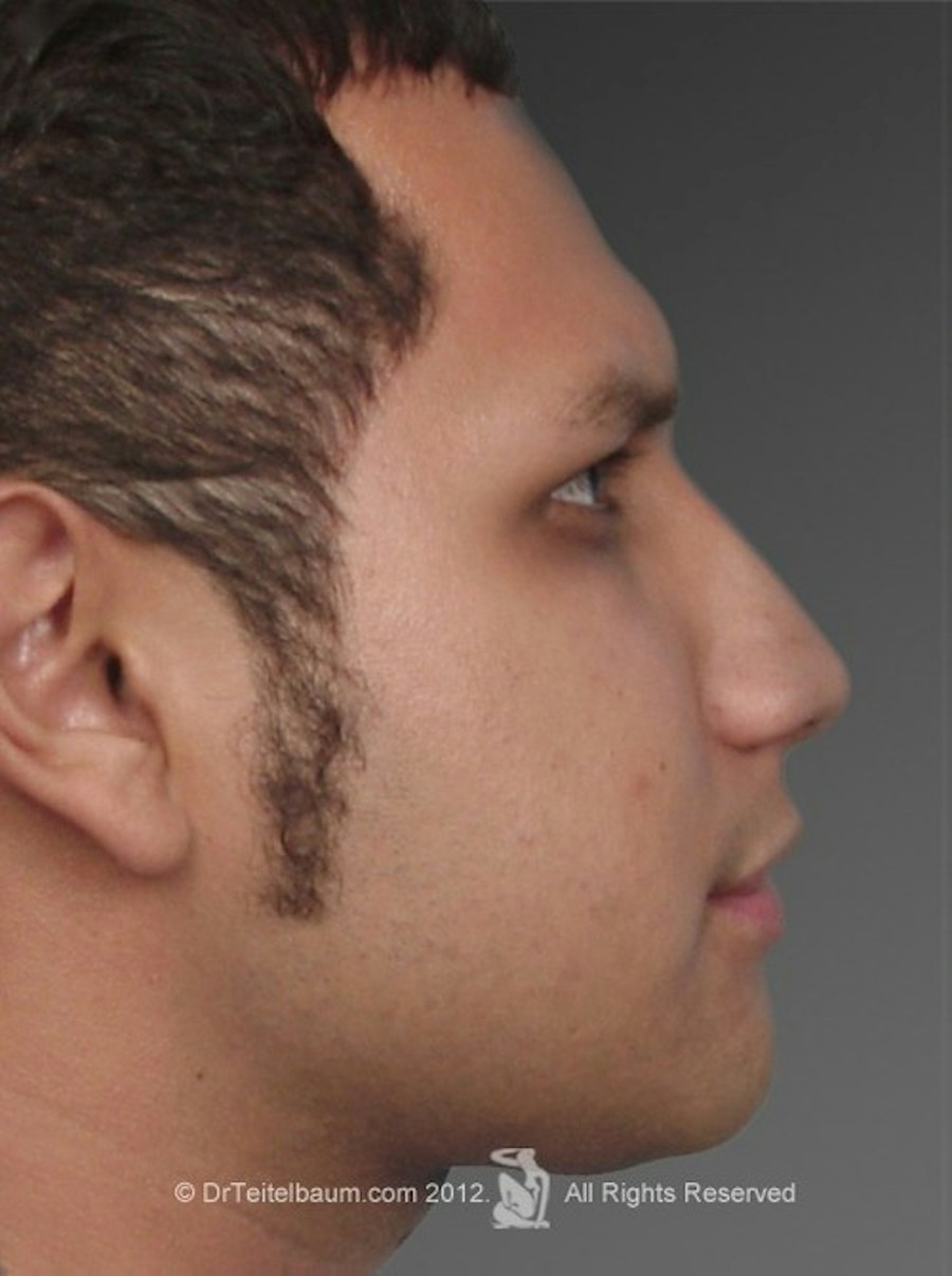 Patient 106009305 | Profile View | After | Men — Steven Teitelbaum MD - Santa Monica