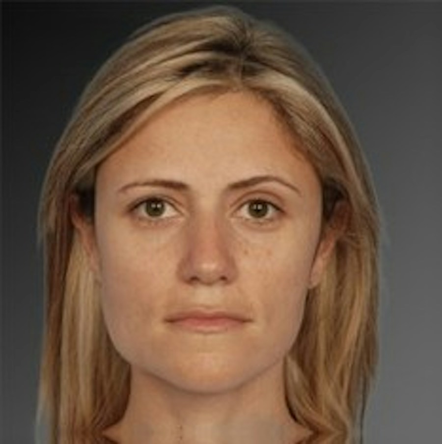 Patient 106009306 | Front View | Before | Rhinoplasty — Steven Teitelbaum MD -