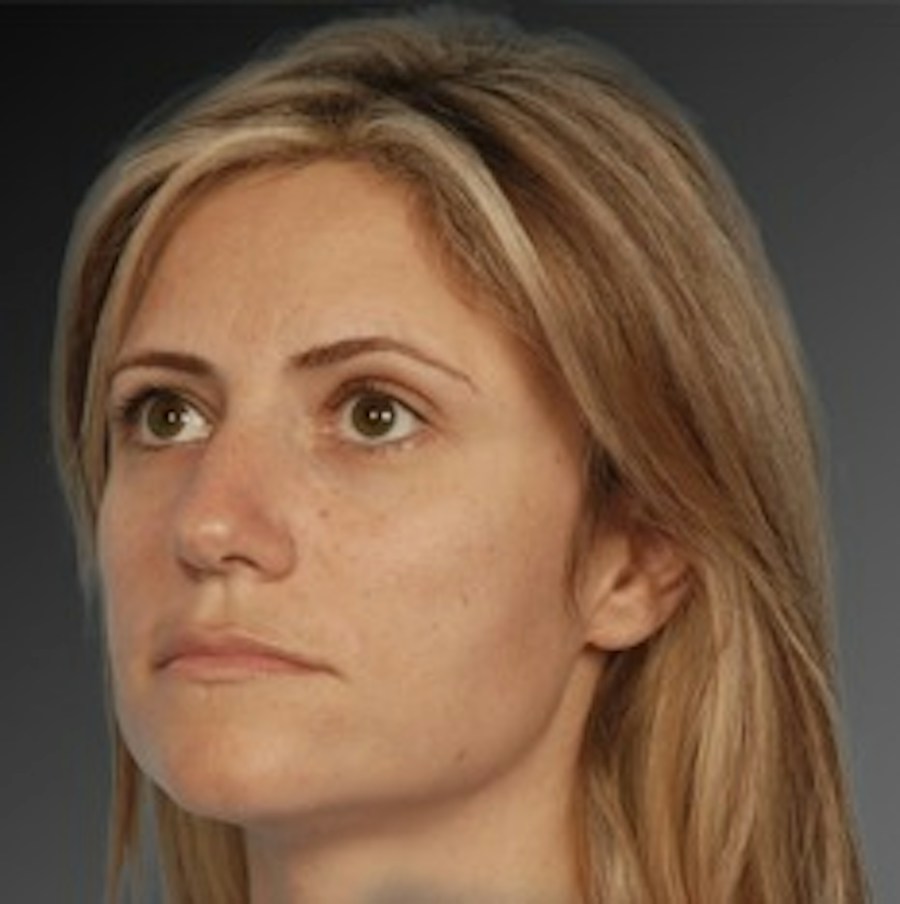Patient 106009306 | Angle View | Before | Rhinoplasty — Steven Teitelbaum MD -