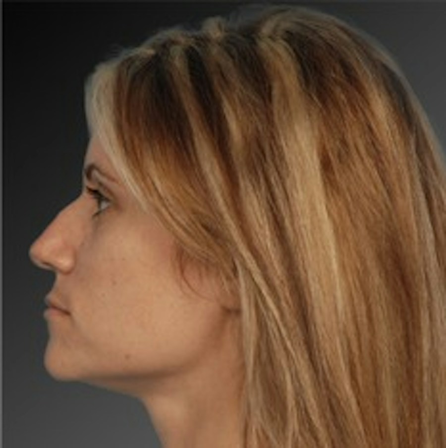 Patient 106009306 | Profile View | Before | Rhinoplasty — Steven Teitelbaum MD -
