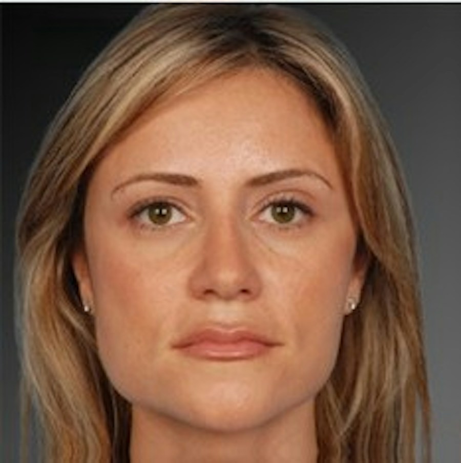 Patient 106009306 | Front View | After | Rhinoplasty — Steven Teitelbaum MD -