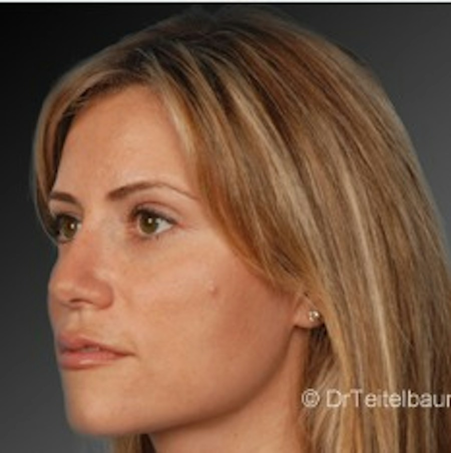 Patient 106009306 | Angle View | After | Rhinoplasty — Steven Teitelbaum MD -