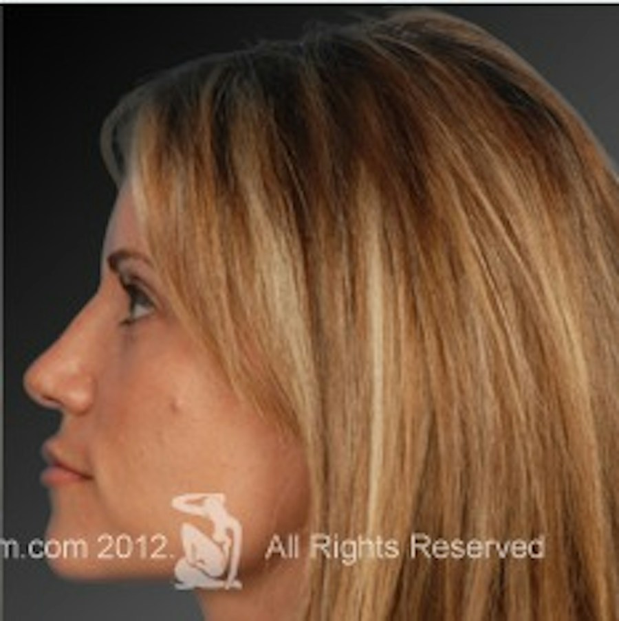 Patient 106009306 | Profile View | After | Rhinoplasty — Steven Teitelbaum MD -