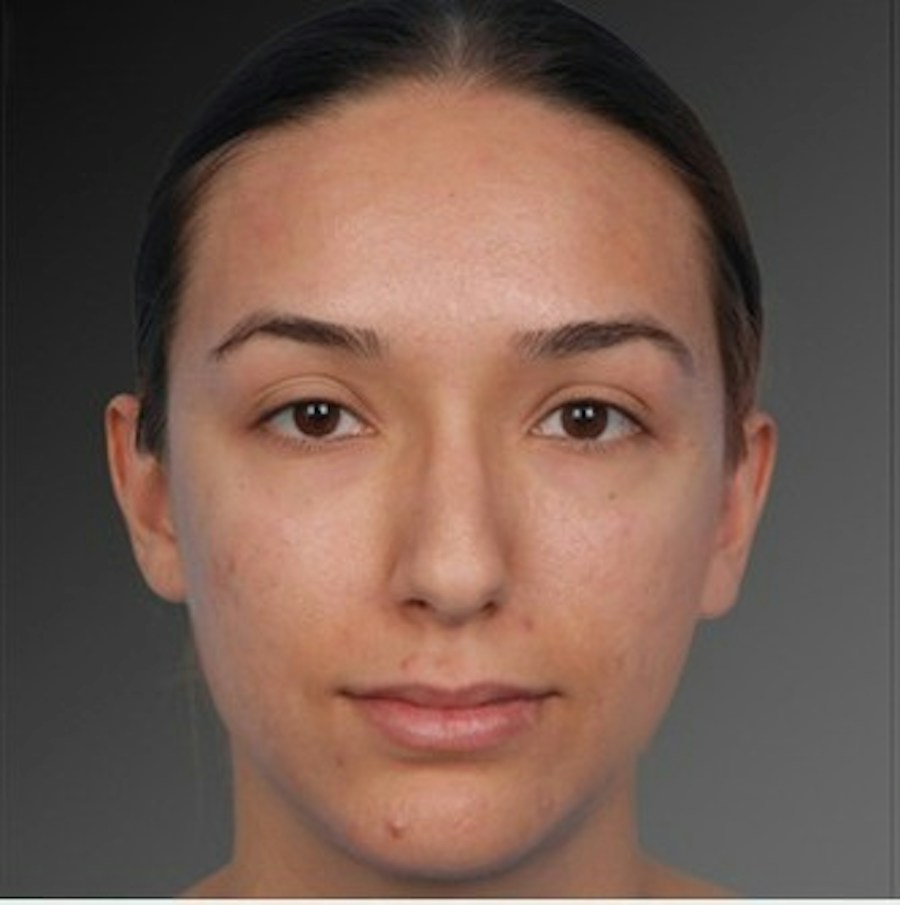 Patient 106009307 | Front View | Before | Rhinoplasty — Steven Teitelbaum MD -