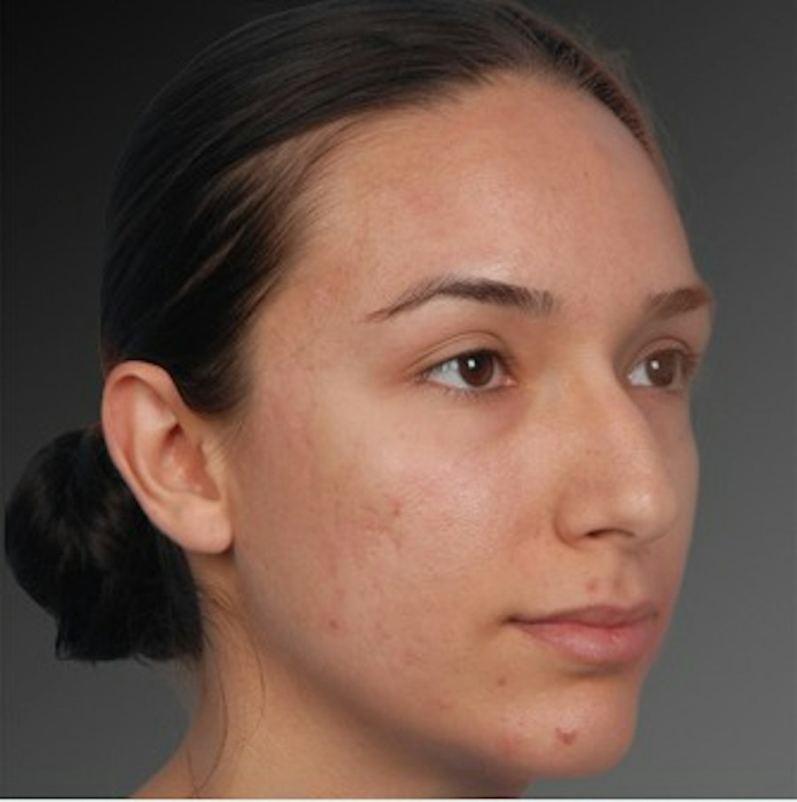 Patient 106009307 | Angle View | Before | Rhinoplasty — Steven Teitelbaum MD -