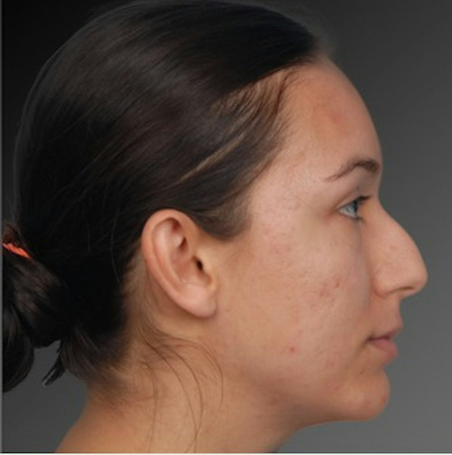Patient 106009307 | Profile View | Before | Rhinoplasty — Steven Teitelbaum MD -
