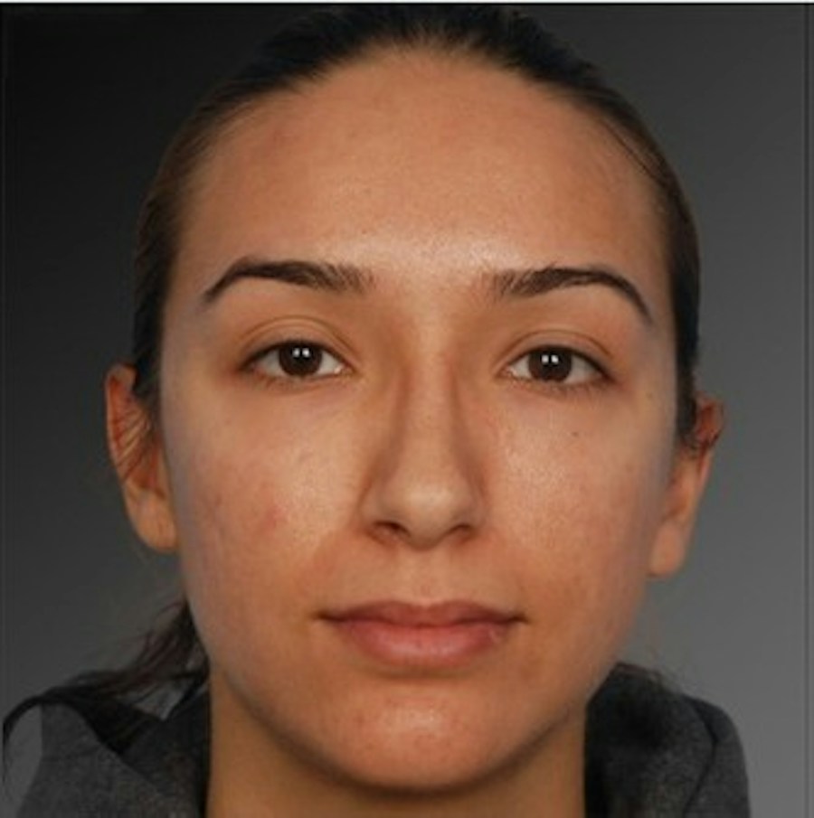 Patient 106009307 | Front View | After | Rhinoplasty — Steven Teitelbaum MD -
