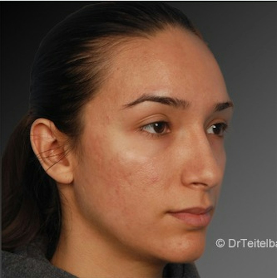 Patient 106009307 | Angle View | After | Rhinoplasty — Steven Teitelbaum MD -