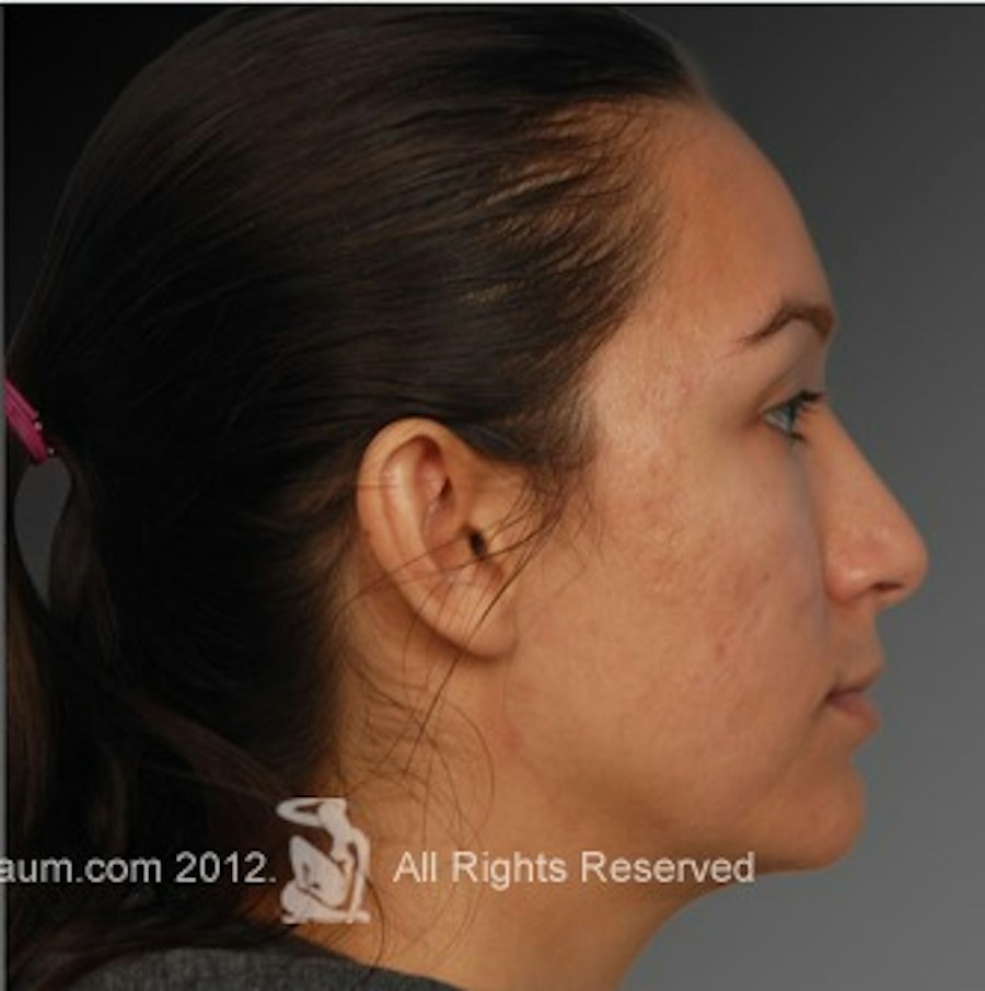 Patient 106009307 | Profile View | After | Rhinoplasty — Steven Teitelbaum MD -