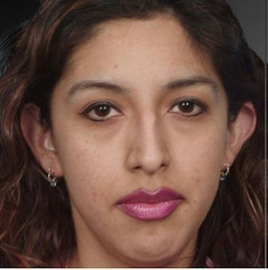 Patient 106009308 | Front View | Before | Rhinoplasty — Steven Teitelbaum MD -