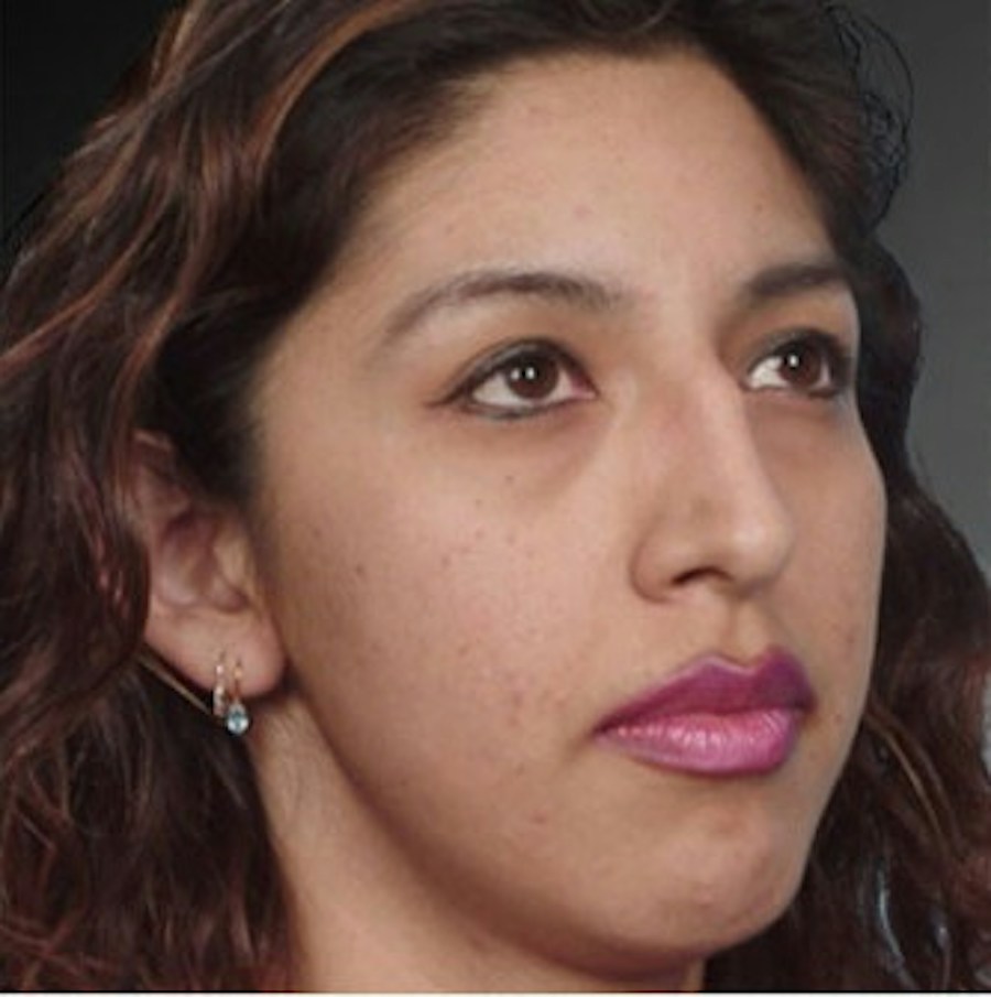 Patient 106009308 | Angle View | Before | Rhinoplasty — Steven Teitelbaum MD -